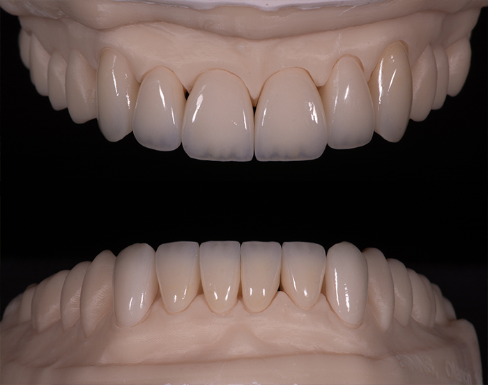 Set of dentures against black background