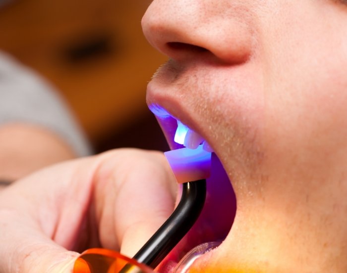 Close up of dentist placing bonding material on a patients upper front tooth