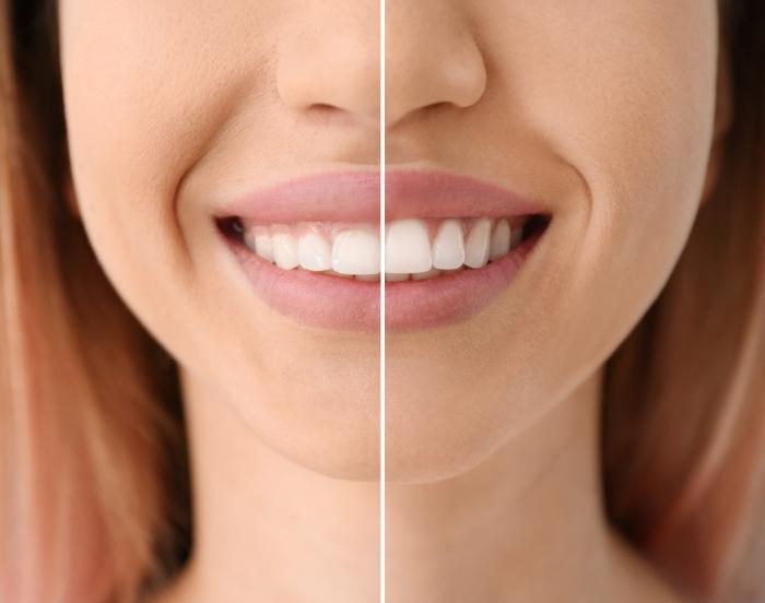 Close up of woman smiling before and after gummy smile correction