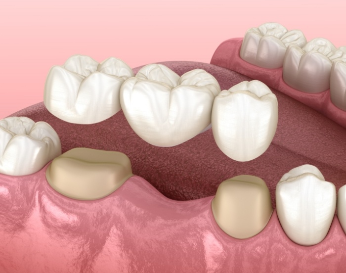 Illustration of a dental bridge being fitted over two teeth to fill the gap between them