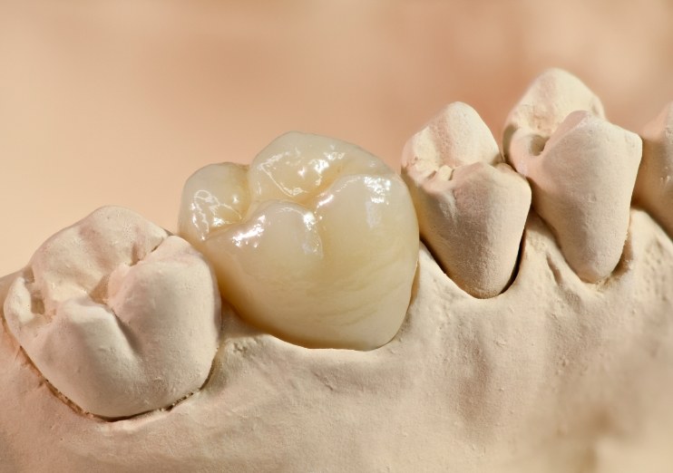 Model of the mouth with a dental crown covering one tooth