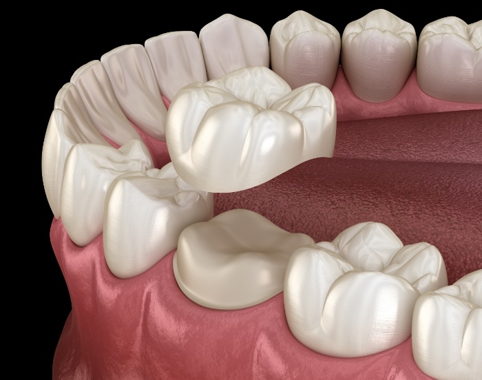 Illustration of a dental crown being fitted over a tooth