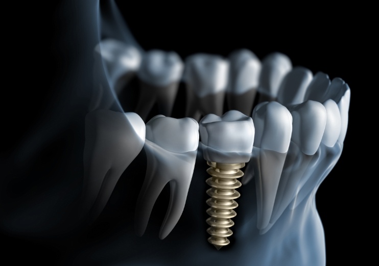 Illustrated x ray of a jawbone with a dental implant replacing one tooth