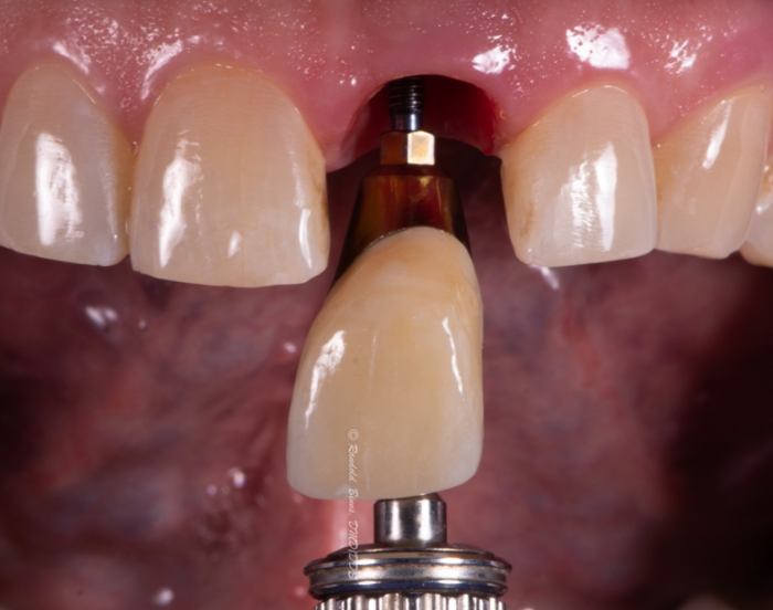 Close up of a dental crown being placed onto a dental implant