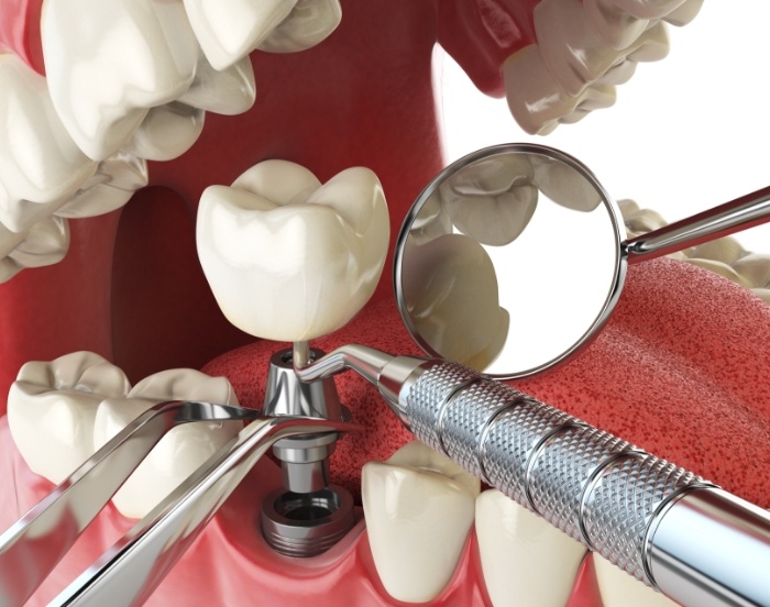 Illustrated dental implant being placed into the lower jaw