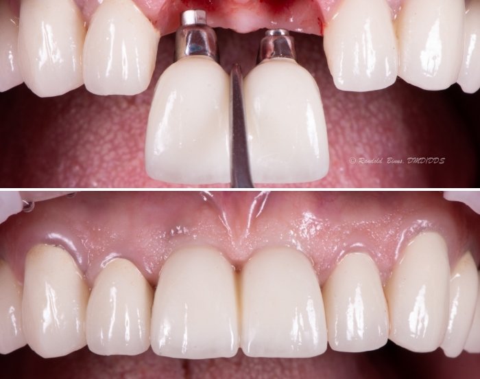 Close up of mouth before and after replacing two upper teeth with dental implants