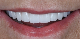 Close up of a smile with a flawless row of upper teeth