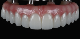 Upper implant denture against black background