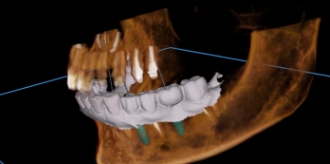 Digital model of dental implants being placed into the jawbone