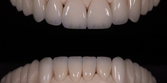 Two arches of flawless prosthetic teeth against black background