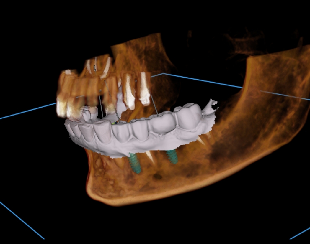 Digital model of dental implants being placed into the lower jawbone