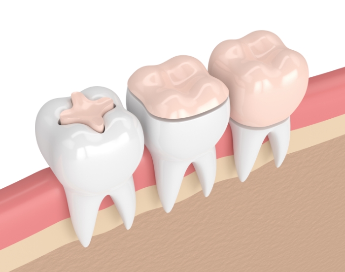 Illustration of three teeth with different sized restorations replacing damaged enamel