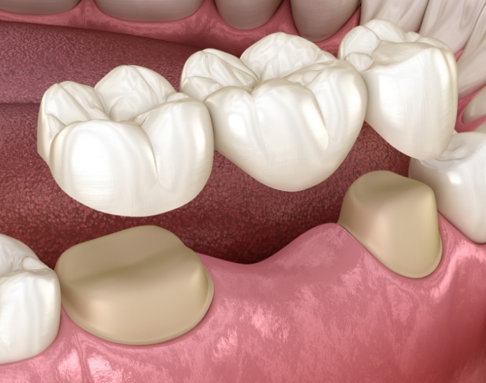 Illustration of a dental bridge being fitted over two teeth to bridge the gap between them