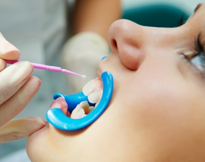 Dental patient having fluoride applied to their teeth