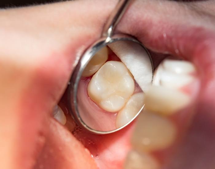 Close up of a dental mirror reflecting a tooth