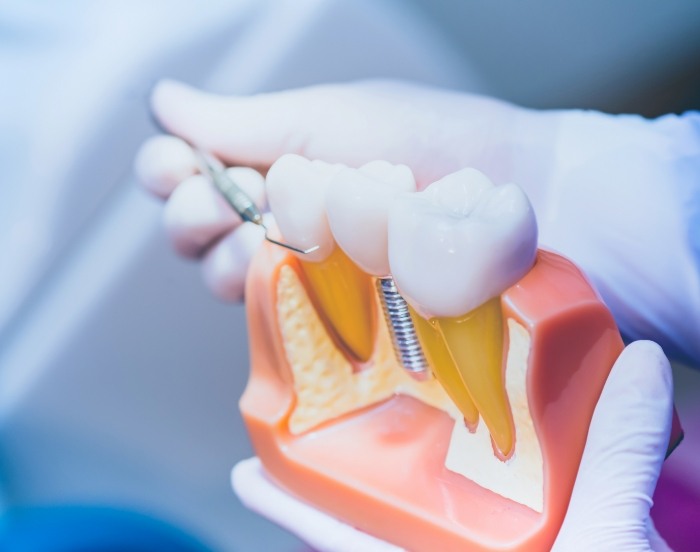 Prosthodontist holding a model of a dental implant in the jawbone