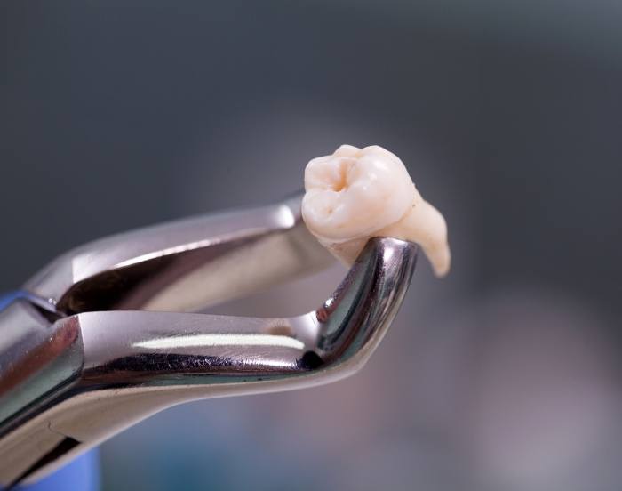 Dental clasp holding an extracted tooth